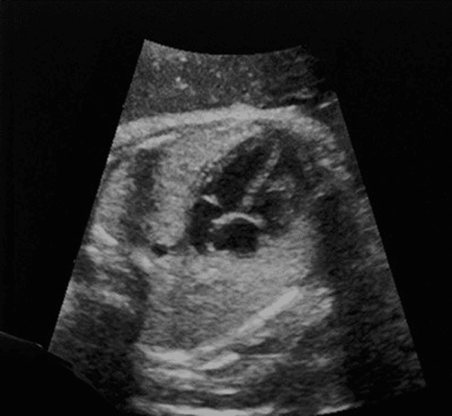 FDA Clears AI Software for Fetal Heart Ultrasound Assessment