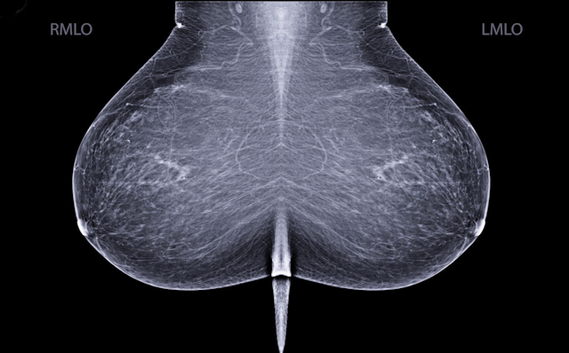 Mammography and Breast MRI: Is it Time to Evaluate Strategies as Opposed to Modalities?