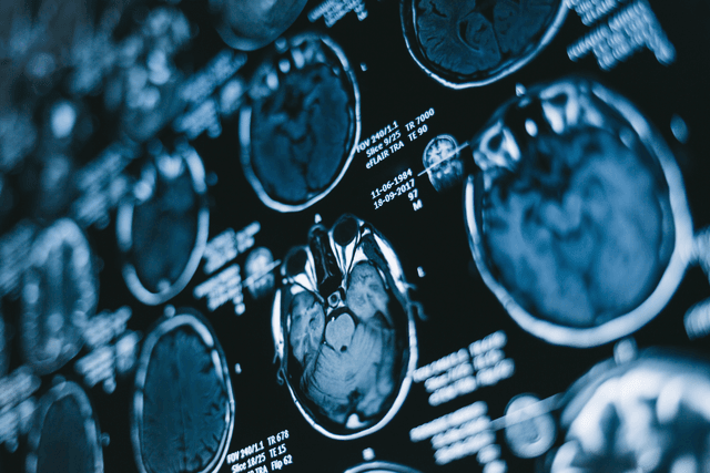 Can Gadolinium-Free MRI Be a Viable Pre-Op Option for Differentiating Diffuse Gliomas?