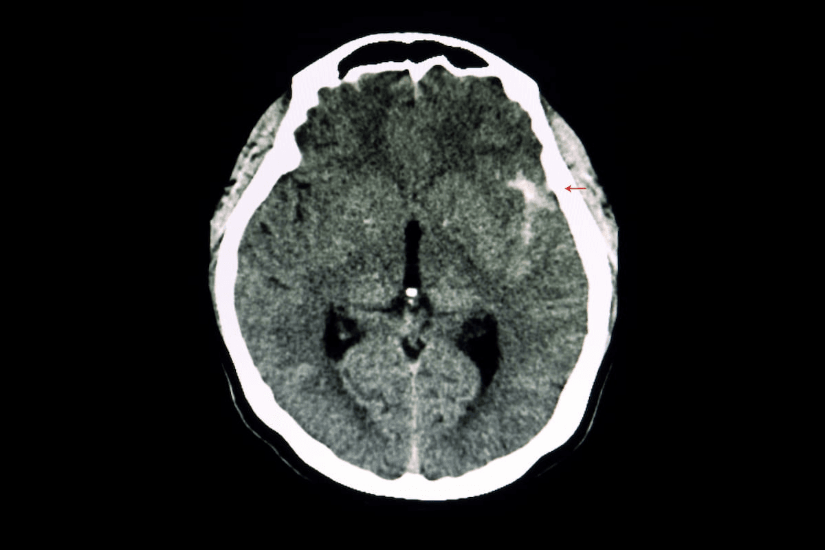 Can Radiomics Enhance Differentiation of Intracranial Aneurysms on Computed Tomography Angiography?