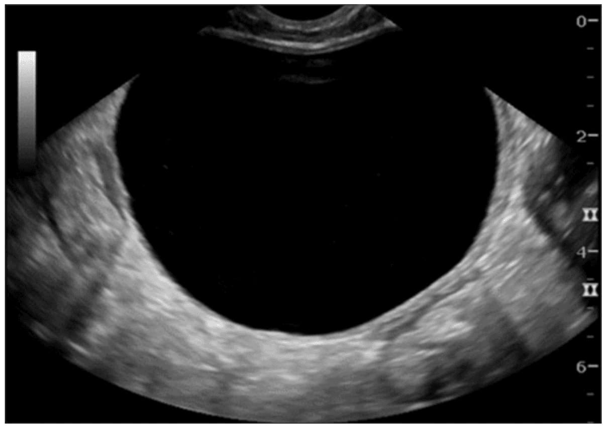 Ultrasound Study: O-RADS Scoring May Prevent Surgery for Over 40 Percent of Ovarian and Adnexal Lesions