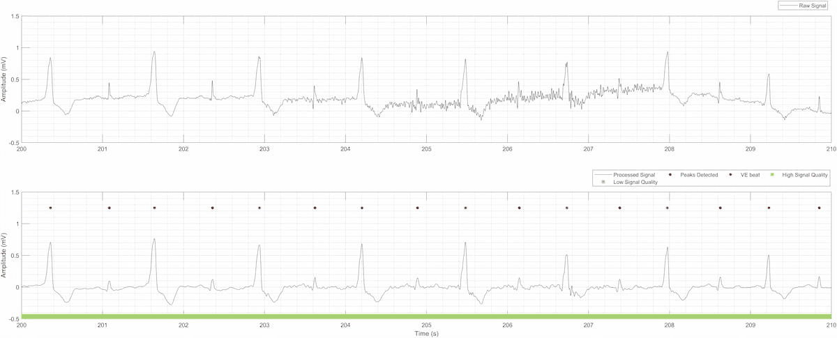 FDA Clears New Electrocardiogram Suite of Algorithms and Analytics