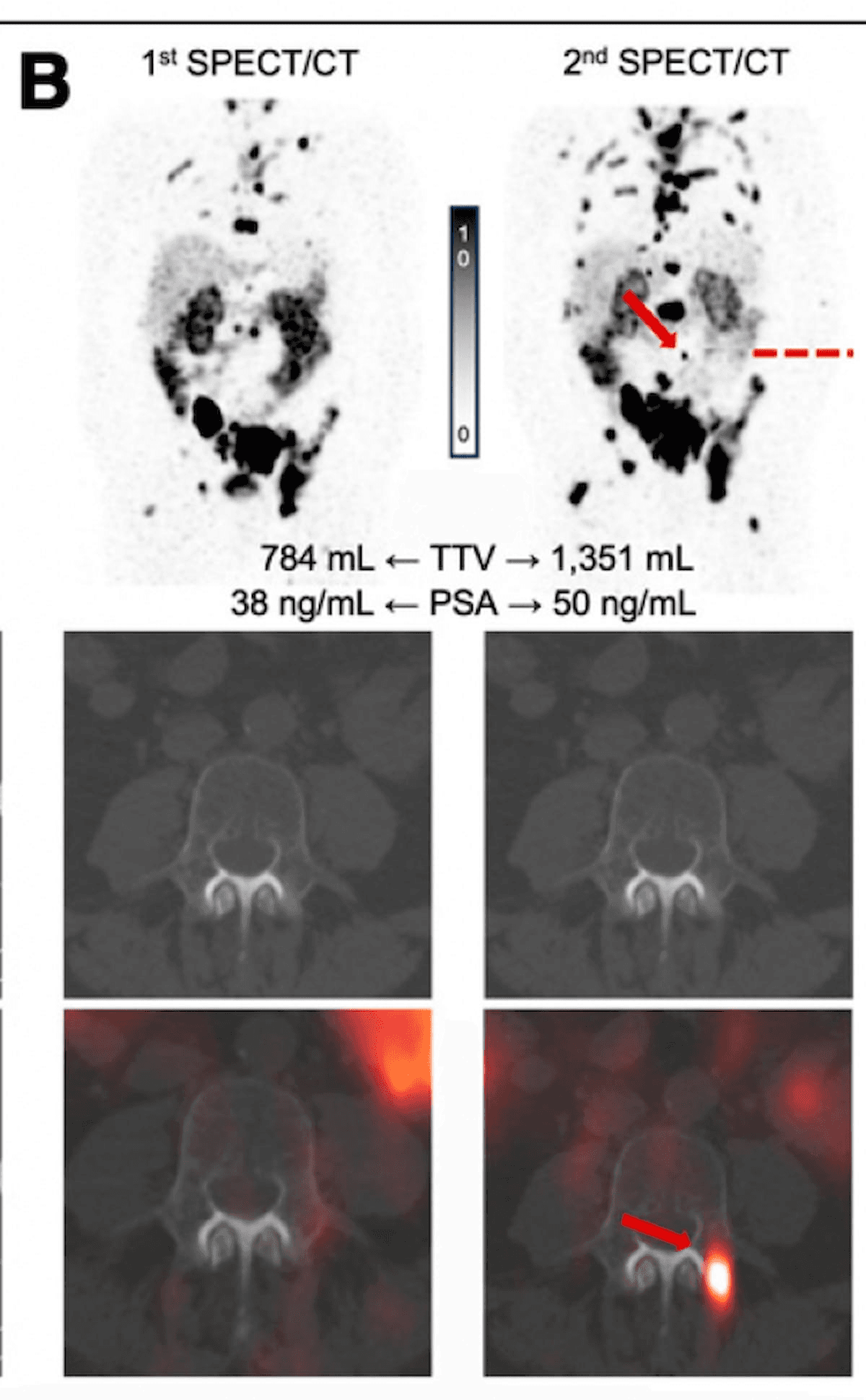 What SPECT/CT May Reveal About Early Treatment Response for Pluvicto in Patients with mCRPC