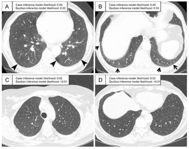 Study Assesses Lung CT-Based AI Models for Predicting Interstitial Lung Abnormality  