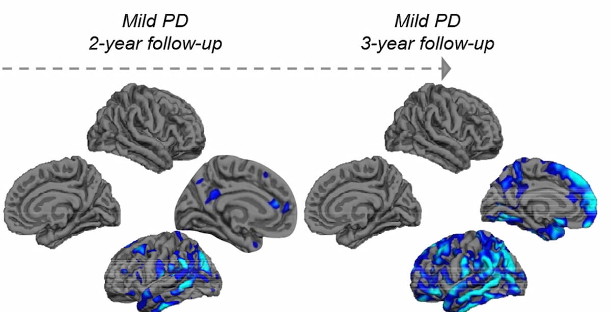 Can Brain MRI-Based Connectome Mapping Predict the Progression of Parkinson’s Disease?