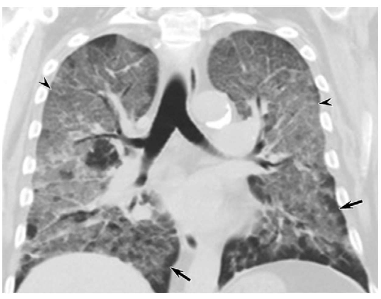 CT Scans Show Vaping-Related Lung Injury Patterns