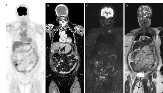 Consensus Recommendations on MRI, CT and PET/CT for Ovarian and Colorectal Cancer Peritoneal Metastases