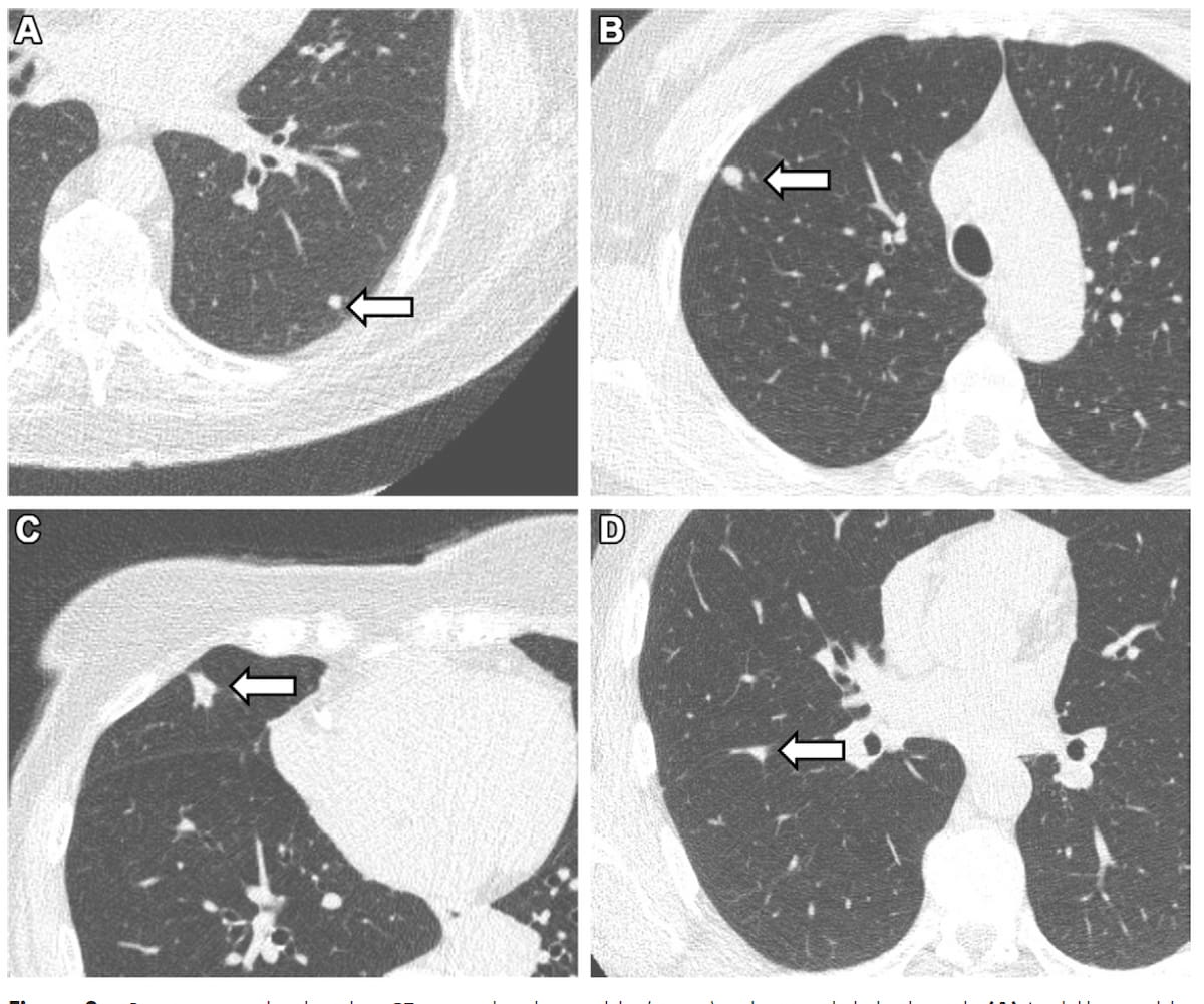 Chest CT Research Reveals at Least One Lung Nodule in 42 percent of Non-Smokers