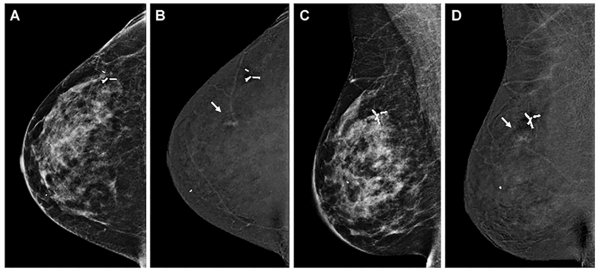 Study: Contrast-Enhanced Mammography Offers Significantly Higher Sensitivity for Breast Cancer in Dense Breasts 