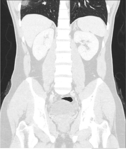 Non-Chest CT Scans Can Reveal COVID-19