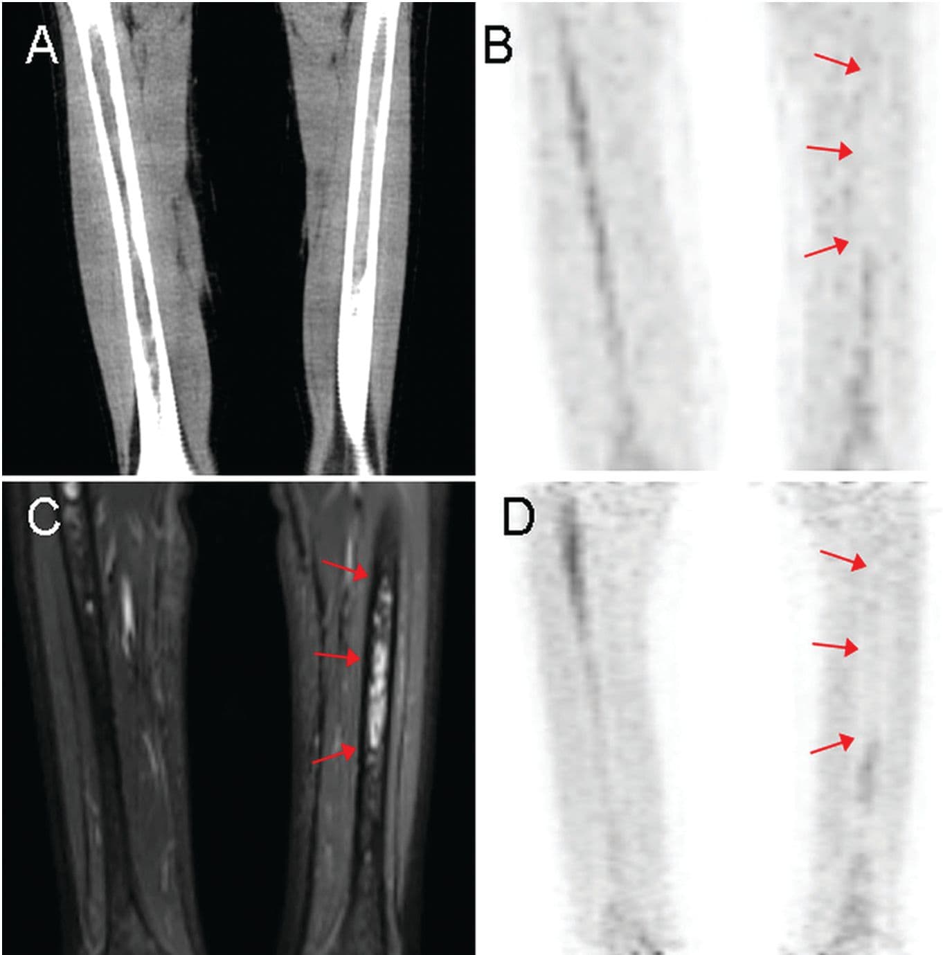 PET/MRI as Effective as PET/CT for Pediatric Tumors 