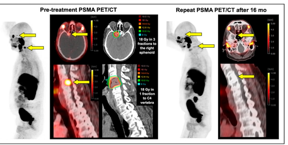 Can Targeted PSMA PET/CT-Guided Radiotherapy Have an Impact for Oligometastatic Prostate Cancer?