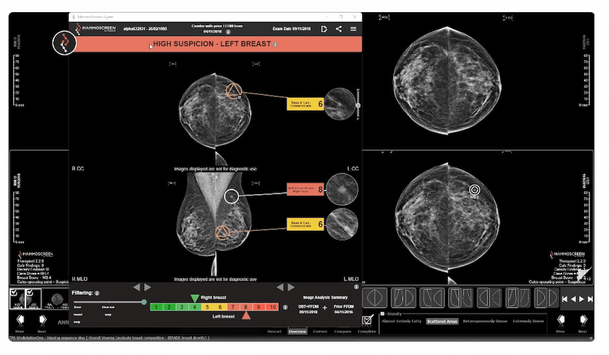 FDA Clears New Features in AI-Powered Mammography Software Suite