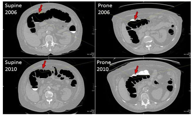 CT Colonography Algorithm Helps Radiologists Recognize Polyps