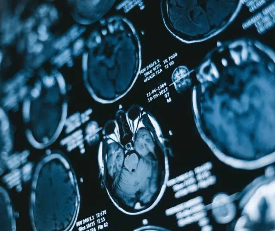 Multicenter Study Shows 26 Percent of Multiple Sclerosis Relapses Not Associated with New Lesions on MRI