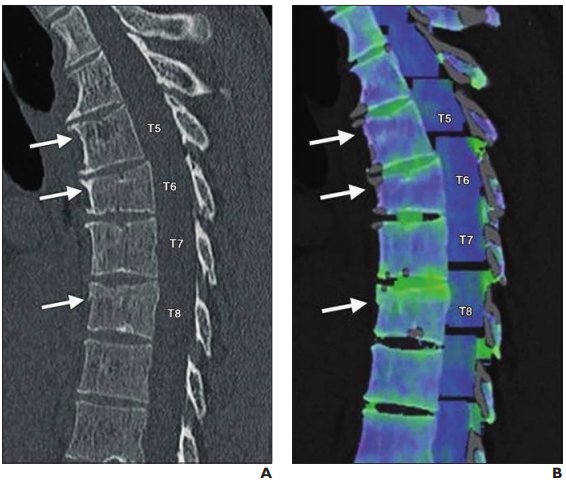 Dual-Energy CT in the ED Brings Greater Confidence