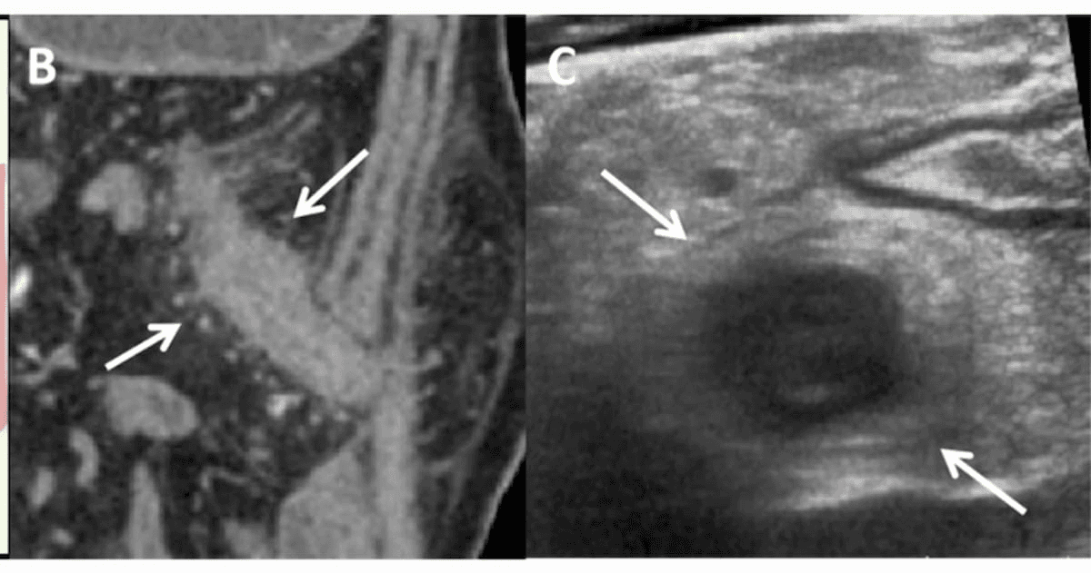 Can Intestinal Ultrasound Provide an Alternative for Evaluating Creeping Fat with Crohn’s Disease?