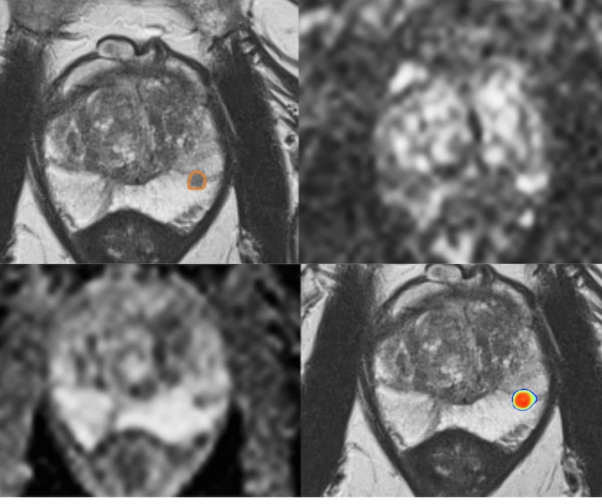 Could MRI-Based AI Offer Better Risk Stratification for Prostate Cancer than PI-RADS?