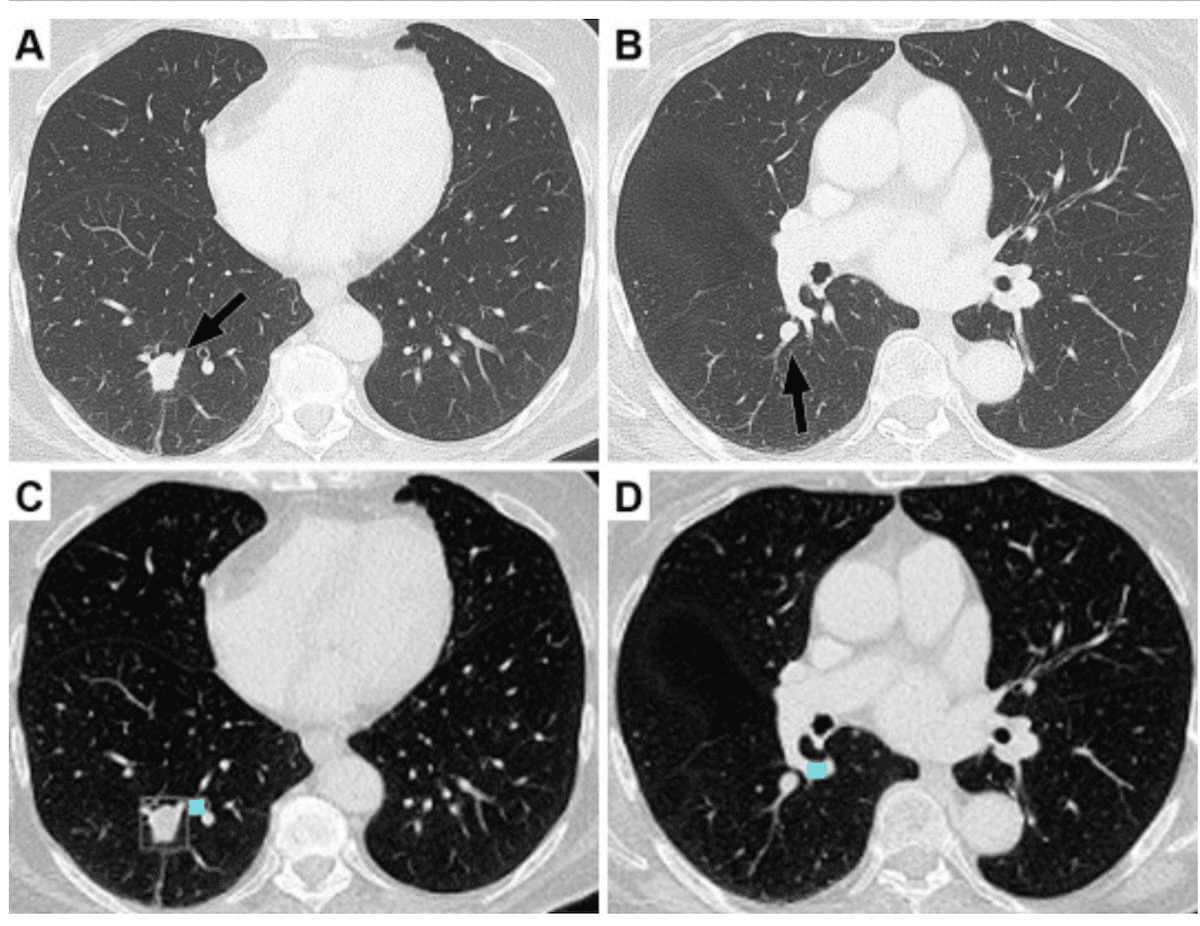 Can Adjunctive AI Facilitate Earlier Lung Cancer Detection on Pre-Op CT Scans?