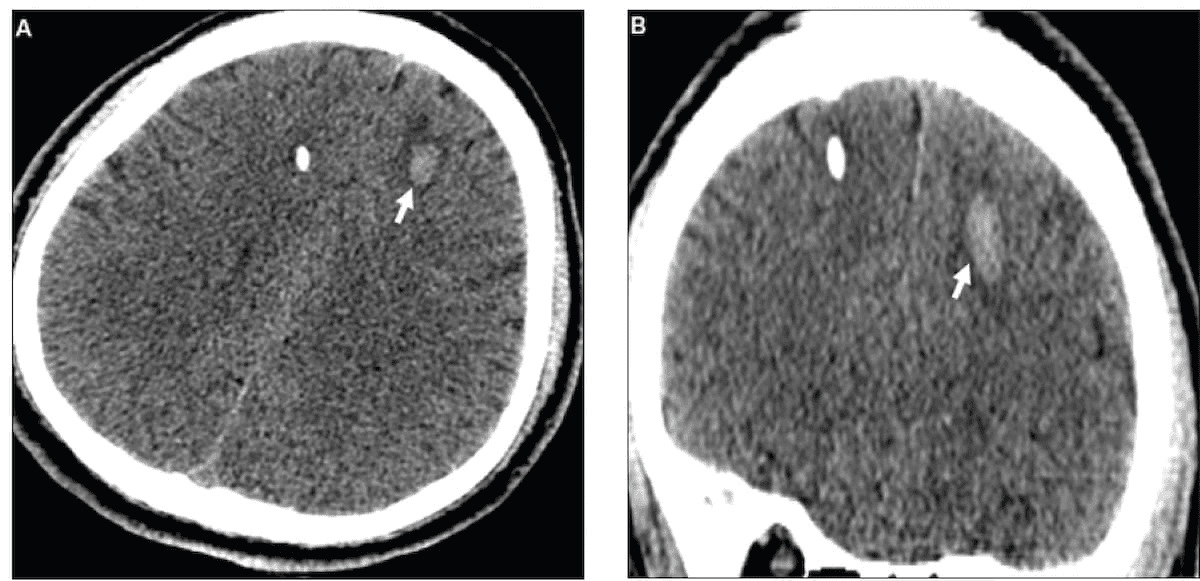 What a Prospective CT Study Reveals About Adjunctive AI for Triage of Intracranial Hemorrhages