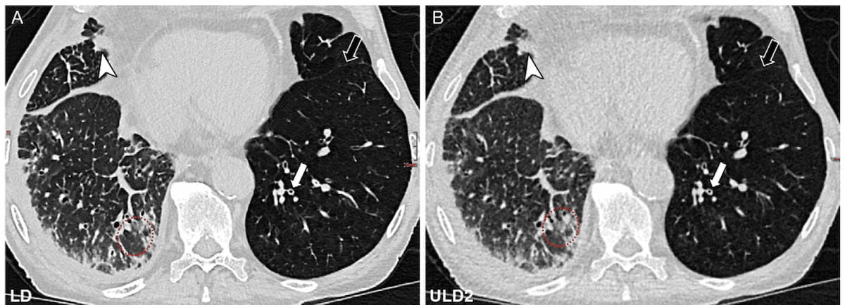 Photon Counting CT Facilitates Tenfold Reduction in Radiation Dosing for Detecting Post-Transplant Lung Deformities