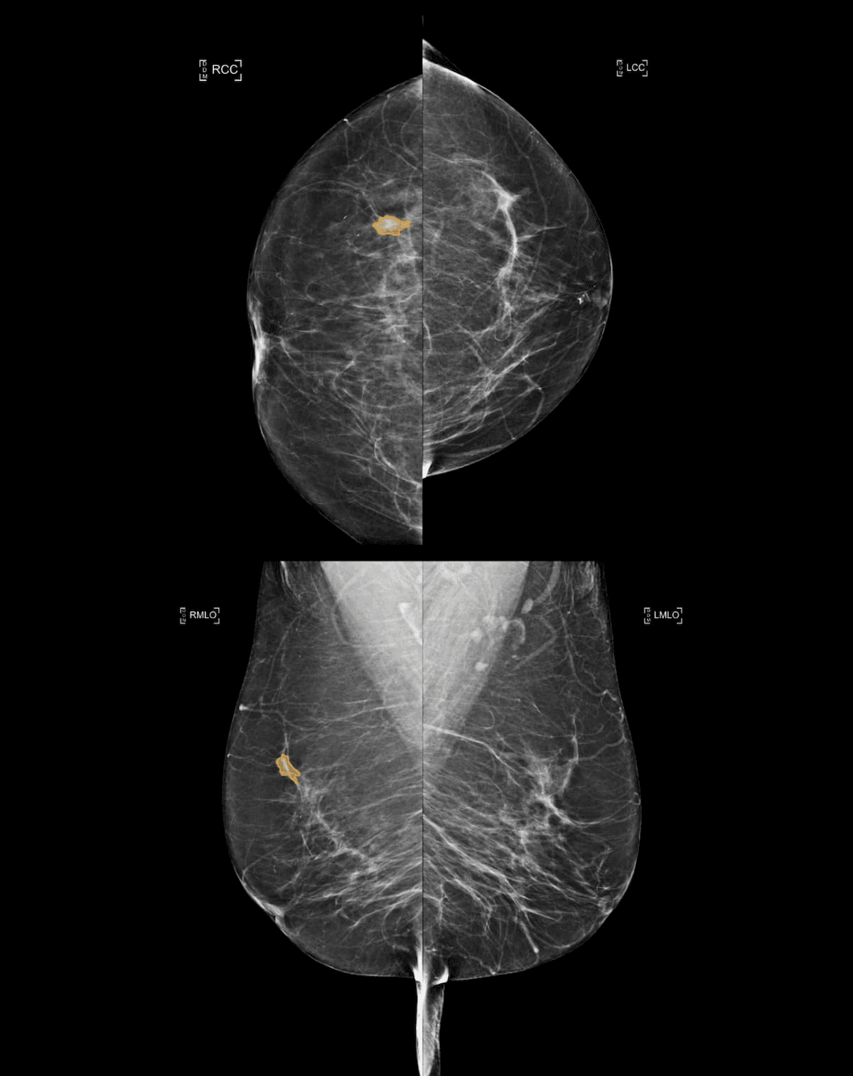 Can an Emerging AI Platform Enhance Real-Time Results for Mammography?