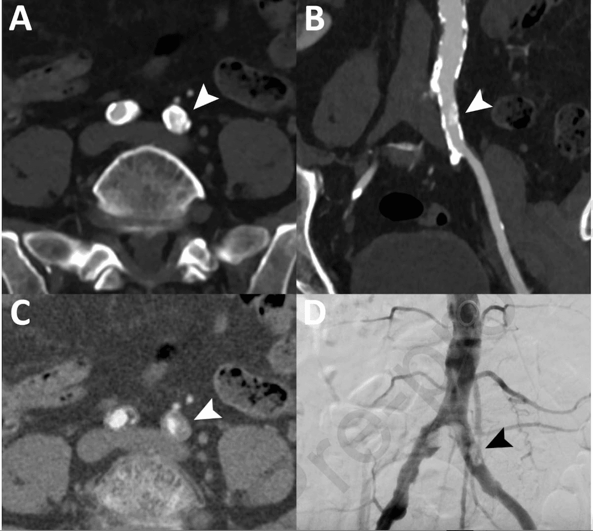 Photon-Counting CTA for Patients with PAD: What the Research Reveals About Assessment for Stenotic Lesions