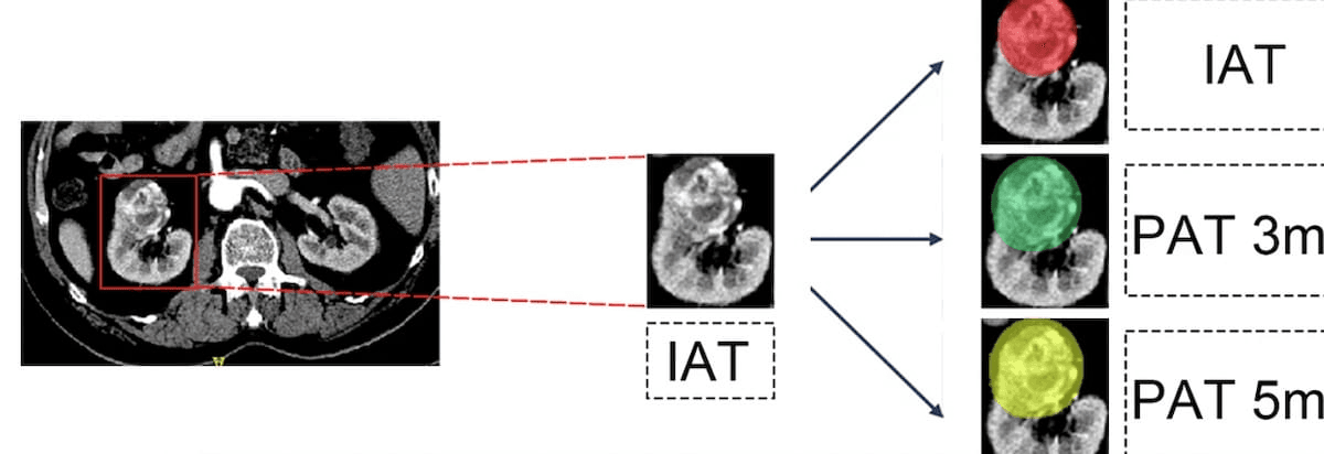 CT-Based Radiomic Model Shows Promise for Pre-Op Staging of Clear Cell Renal Cell Carcinoma