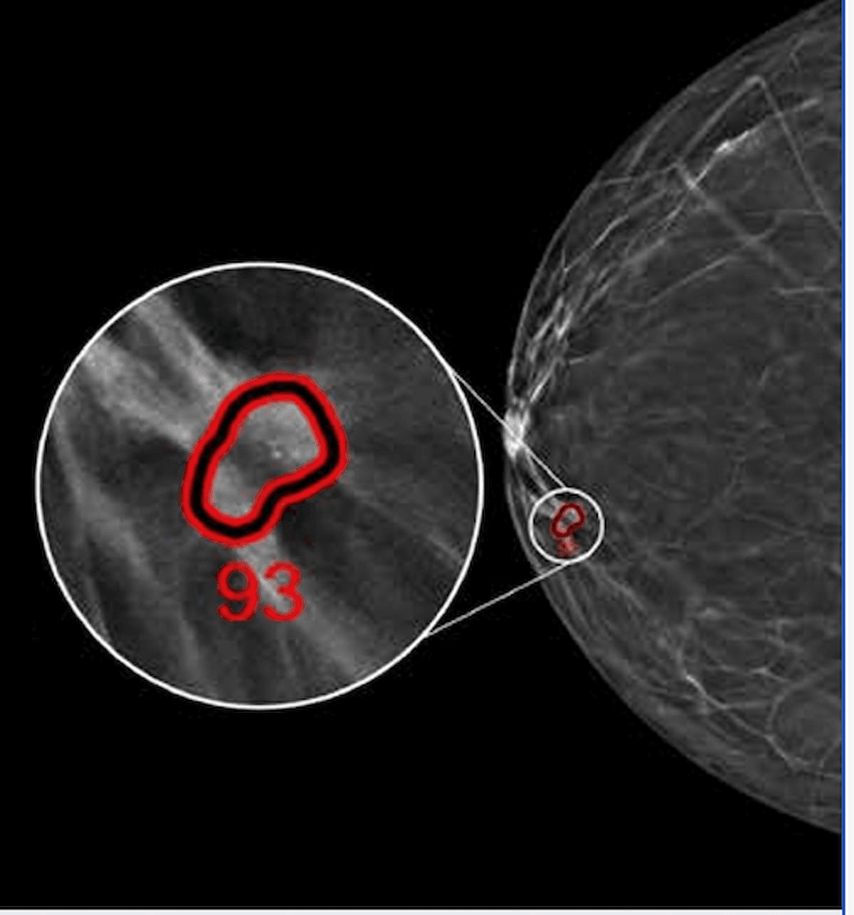 FDA Clears Updated AI Platform for Digital Breast Tomosynthesis