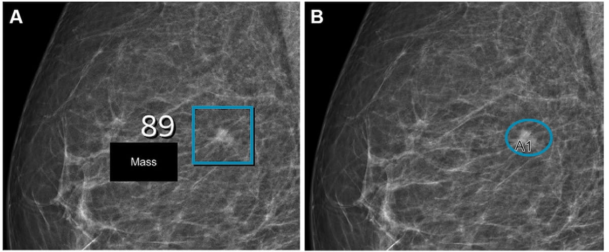 Use of Mammography AI Leads to 12 percent CDR Increase and 20 Percent Decrease in Recall Rate