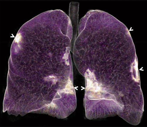 3D CT of Patient Positive for COVID-19 Pneumonia