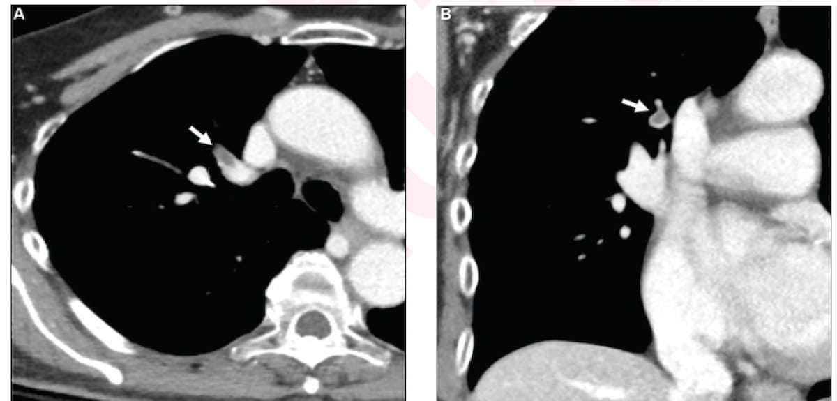 Adjunctive AI Leads to 16 Percent Increase in CT Sensitivity for Incidental Pulmonary Embolism
