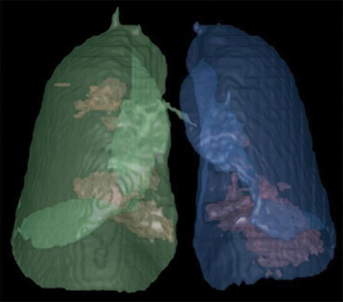 CT Reveals Differences Between COVID-19 and Influenza Pneumonias