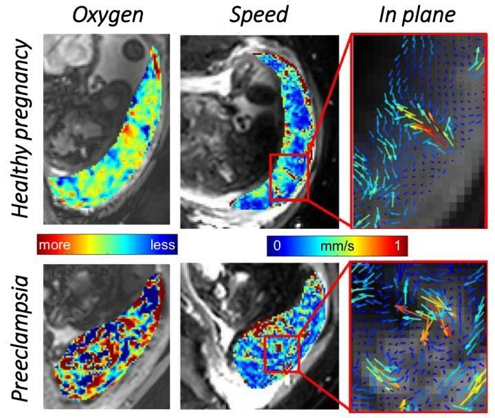 MRI Reveals New Uterine Mechanism That Improves Blood Flow to Fetus