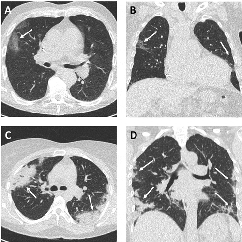 Low-Dose CT Could Be COVID-19 Assessment Tool