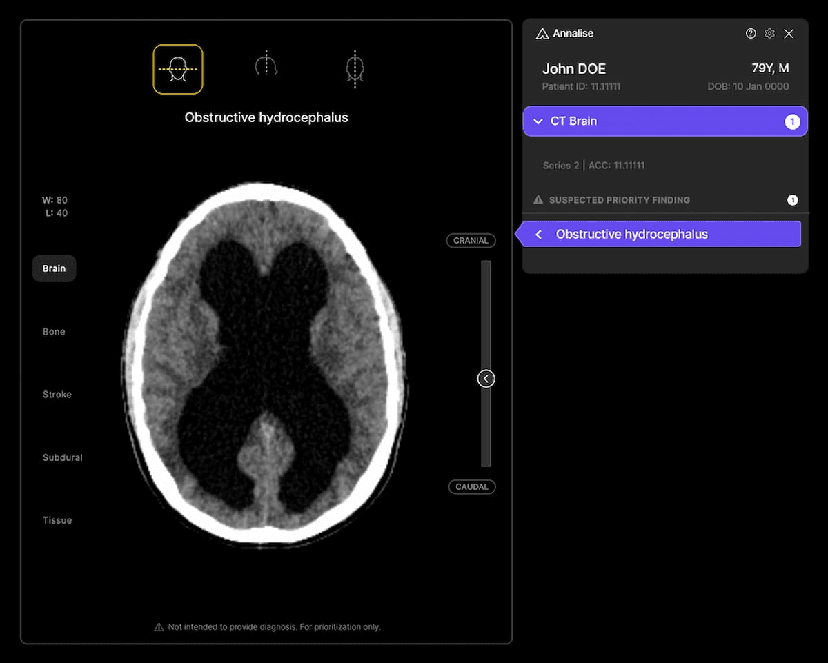 CMS Approves NTAP Reimbursement for CT-Based AI Triage Software for Obstructive Hydrocephalus