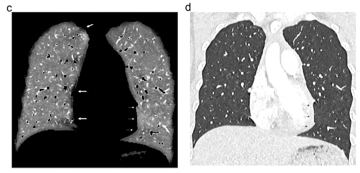 Can Photon-Counting CT Provide Superior Lung Perfusion Imaging Over Dual-Energy CT?