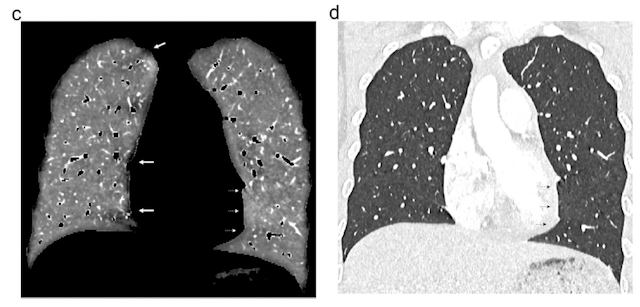 Can Photon-Counting CT Provide Superior Lung Perfusion Imaging Over Dual-Energy CT?