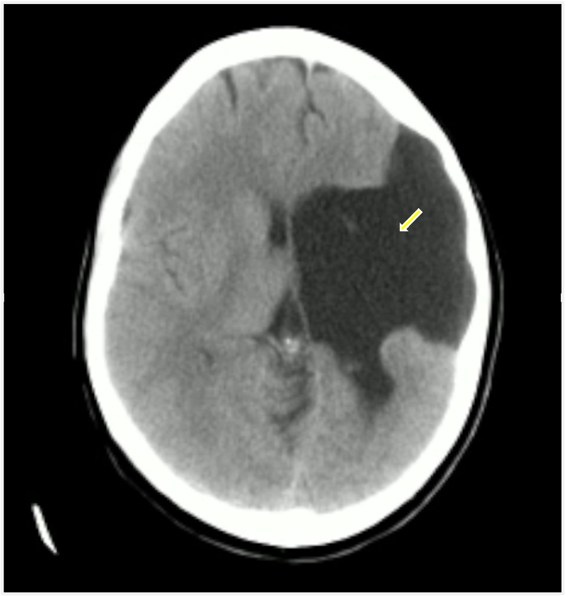 Image IQ Quiz: 36-year-old with Chronic/Developmental Cognitive Impairment and New Seizure Disorder