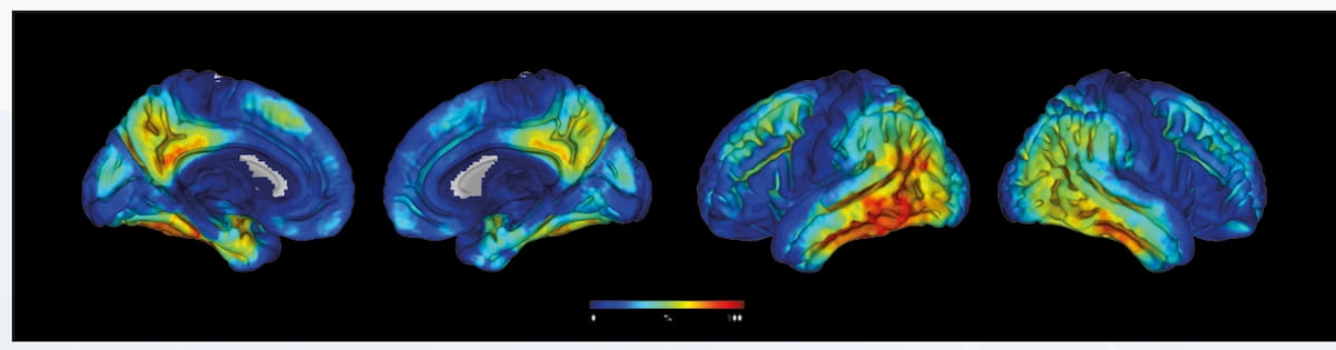 FDA Grants Fast Track Designation to Emerging Tau PET Imaging Agent