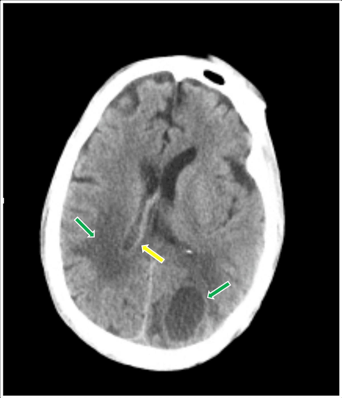 Green arrows: Multiple hypodense lesions with vasogenic edema

Yellow arrows: Hyperdense ependyma