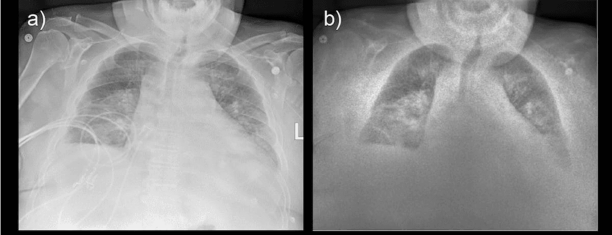 Can Portable Dual-Energy X-Ray be a Viable Alternative to CT in the ICU?