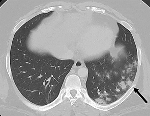 Abdominal Pain: An Unusual -- But Not Rare -- COVID-19 Presentation