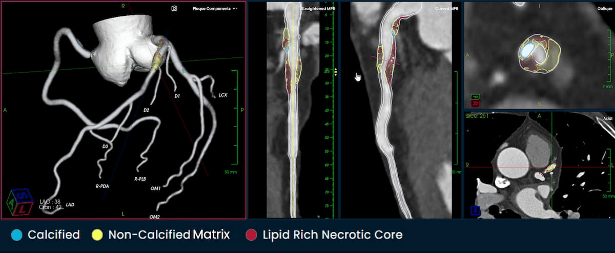 FDA Clears Software for Enhancing CCTA Assessment of Atherosclerosis 