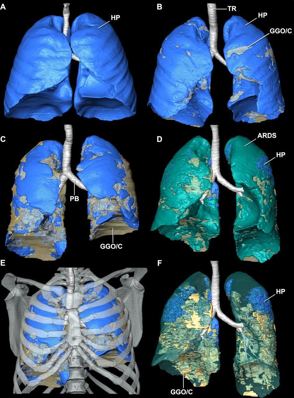 Evolutionary Science Methods Help Create 3D CT Models of COVID-19 Damage