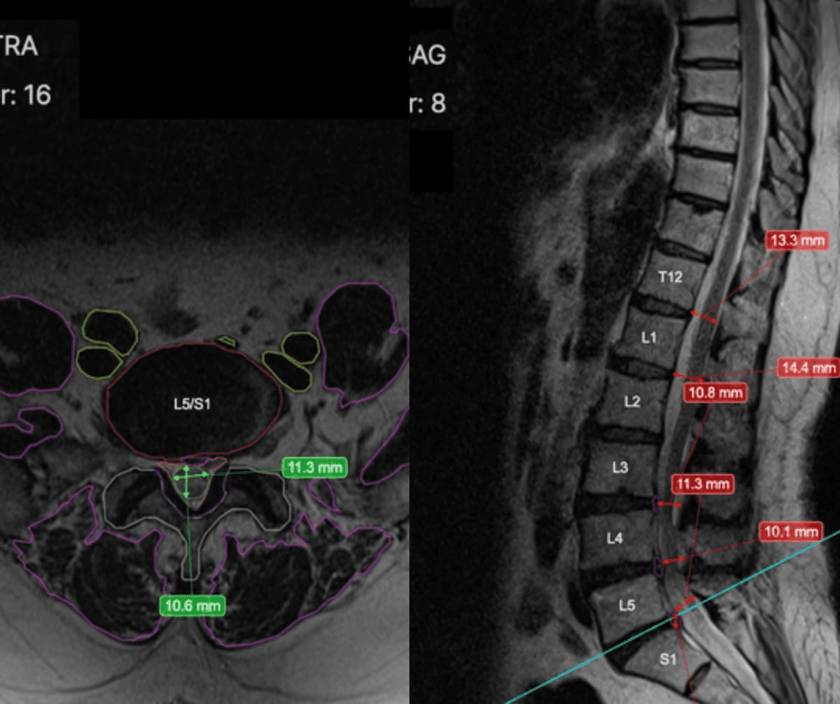 FDA Clears New AI-Powered Spine MRI Software