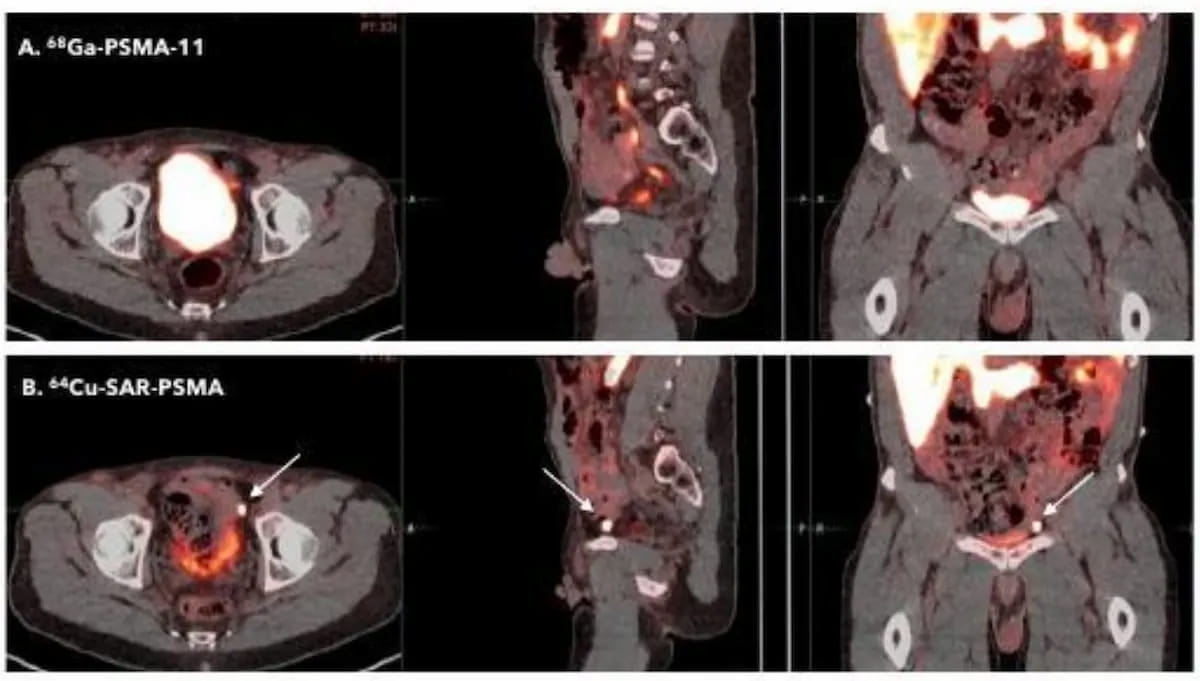 FDA Grants Fast Track Designation to 64Cu-SAR-bisPSMA PET Agent for Prostate Cancer