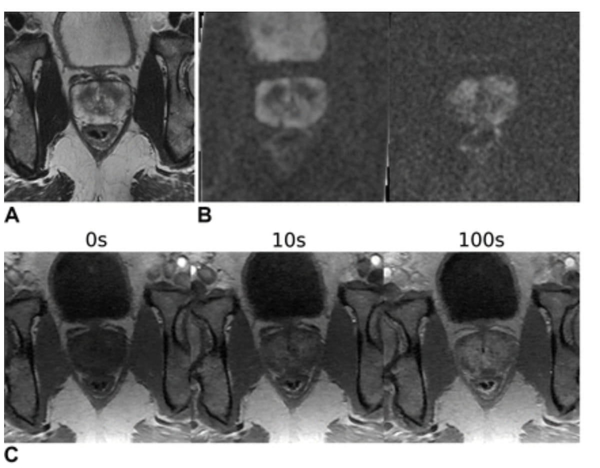 MRI Study Suggests Deep Learning Model Offers Equivalent Detection of csPCA as Experienced Radiologists