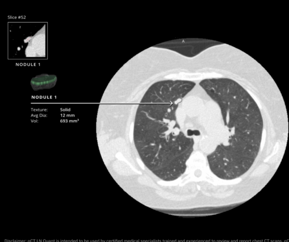 FDA Clears Advanced Lung Nodule Assessment Software for CT Scans