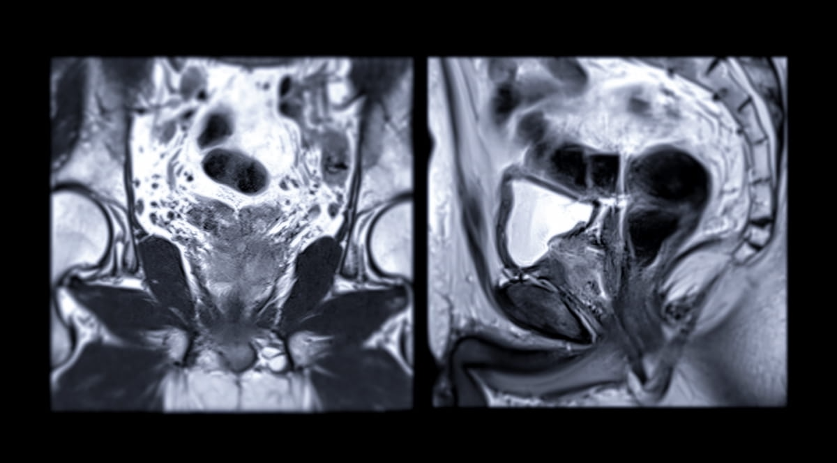 Should MRI be Mandatory Prior to Active Surveillance Decisions for Patients with Intermediate Risk Prostate Cancer?